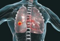 Mesothelioma Impact Of Mesothelioma Lung Cancer