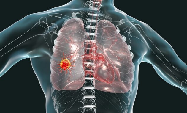 Mesothelioma Impact Of Mesothelioma Lung Cancer