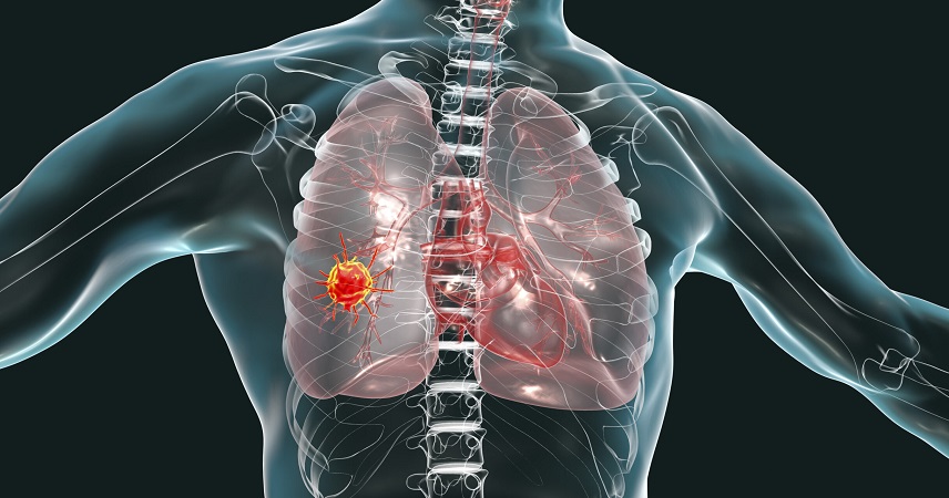 Mesothelioma Impact Of Mesothelioma Lung Cancer